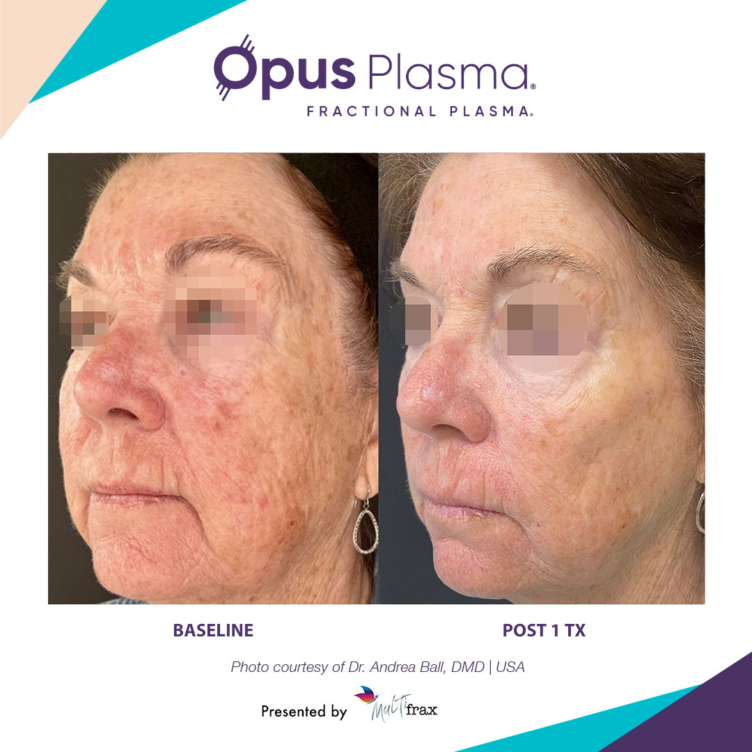 Image shows the skin resurfacing result after 1 Opus treatment session.