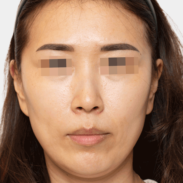 Image of patient after 12 months of using the Lorient Filler