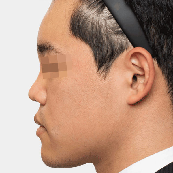 Image of patient after 12 months of using the Lorient Filler