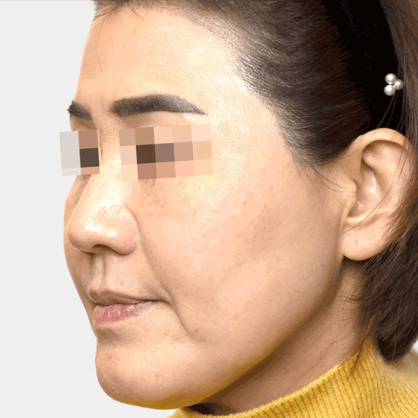 Image of patient after 12 months of using the Lorient Filler